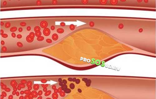 холестериновые бляшки