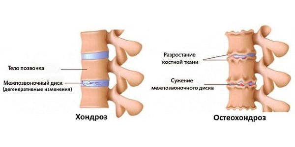 Со временем хондроз может перейти в стадию остеохондроза
