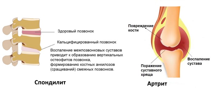 Используют Фламакс Форте при воспалении и боли в суставах