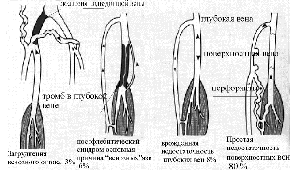 причины недостатка кровотока в венах ног