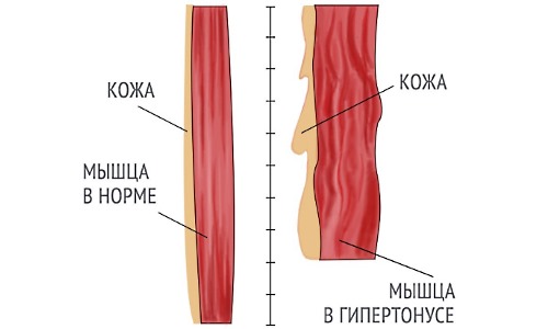 Назначают Мидокалм преимущественно при мышечных спазмах
