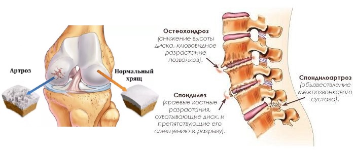 Назначают препараты на основе гидролизат коллагена при дегенеративных изменениях в хрящевой ткани