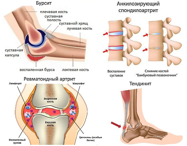 Теноксикам назначают для лечения ревматических заболеваний