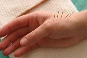иглоукалывание руки