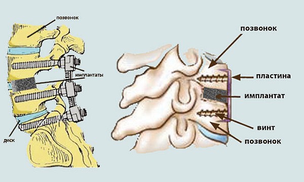 При спондилодезе к позвоночнику крепятся металлические пластины