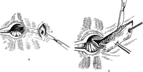 методы иссечения свища