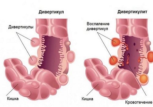 Дивертикулит кишечника