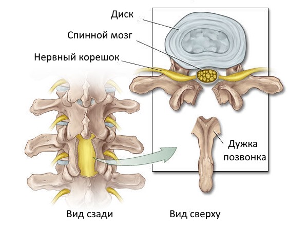 Наиболее радикальный метод лечения остеоартроза позвоночника - ламинэктомия
