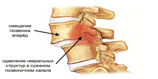 Боль возникает по причине дистрофических изменений или смещения позвонков