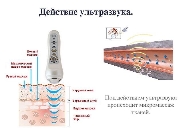 Ультразвуковое лечение, как и электрофорез, включает в себя применение лечебных средств