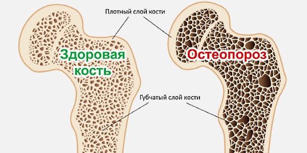 Фосаванс Форте назначают при остеопорозе и дефиците витамина D