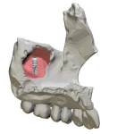 Имплантаты в гайморовой пазухе: неслучайные находки