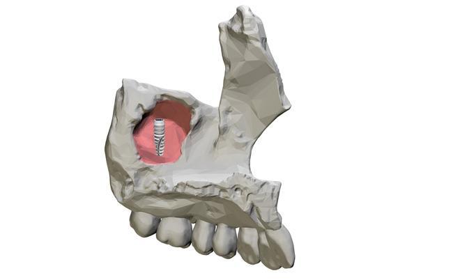 Имплантаты в гайморовой пазухе: неслучайные находки