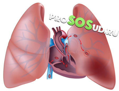 инфаркт лёгкого