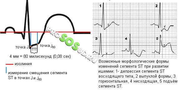 инфаркт миокарда по экг