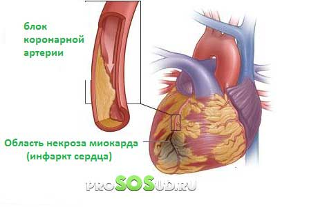 инфаркт сердца