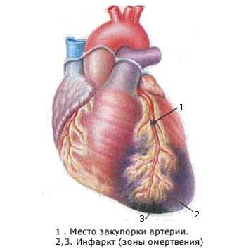 инфаркт сердца