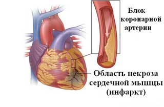 инфаркт сердца