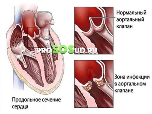 эндокардит