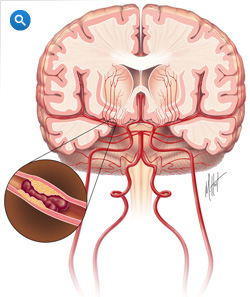 Ишемический инсульт