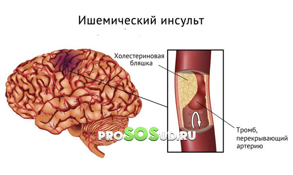 ишемический инсульт