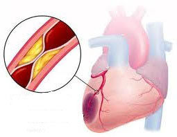 ишемия сердца