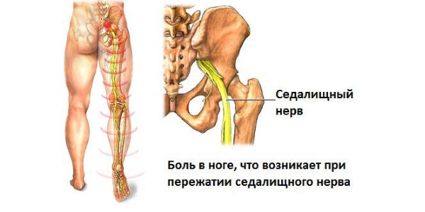 Депос снимает воспаление при ишиасе