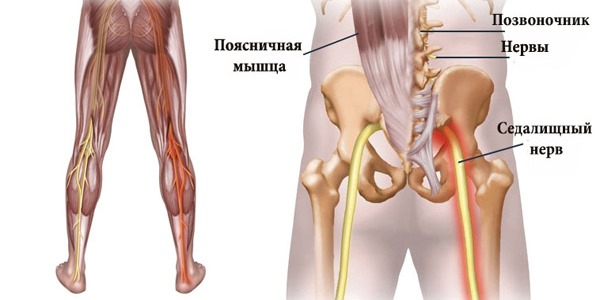 Ишиас - это воспаление седалищного нерва