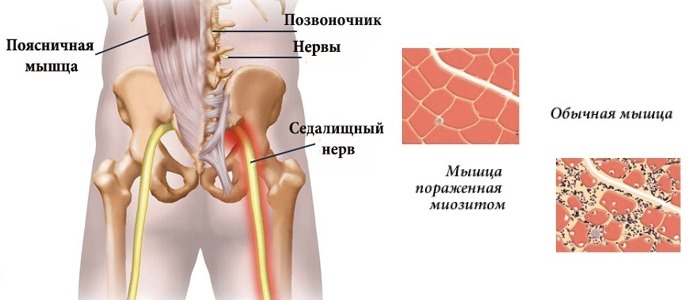 Благодаря обезболивающему и противовоспалительному свойству мазь назначают при ишиасе и миозитах