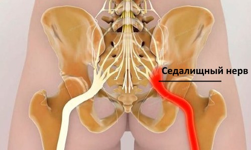 Ишиас возникает из-за патологических изменений в позвоночнике, что приводит к сдавливанию седалищного нерва