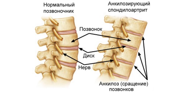 Назначают Мелбек при болезни Бехтерева, артрозе, артрите