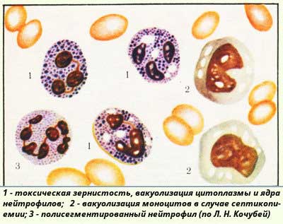 изменения лейкоцитов