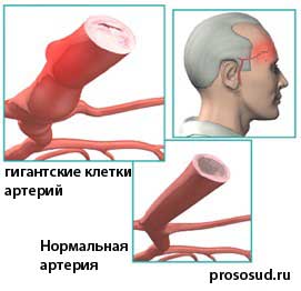 изменения височных артерий