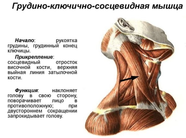 Одна из причин кривошеи - аномальное развитие мышц шеи