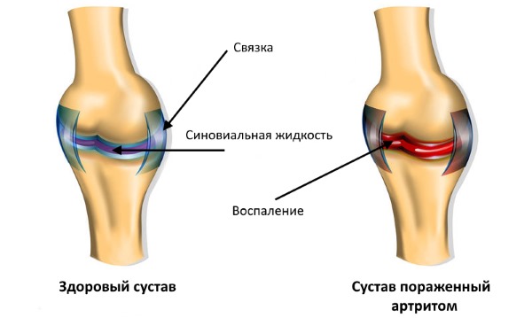 Назначают Синметон при артрите и остеоартрите