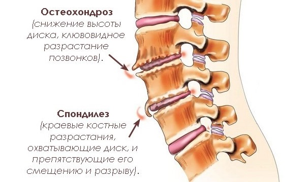 При остеохондрозе боль носит постоянный характер