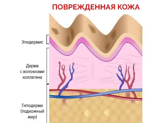 Нельзя наносить Спазгель на поврежденные участки кожи
