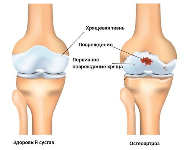 Ежегодно одно из лидирующих мест занимает остеоартроз суставов