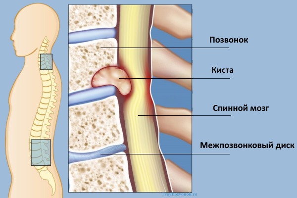 Киста позвоночника - это доброкачественная опухоль