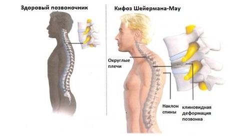Консервативное лечение используют, если искривления незначительные, такие как при болезни Шейерман-Мау