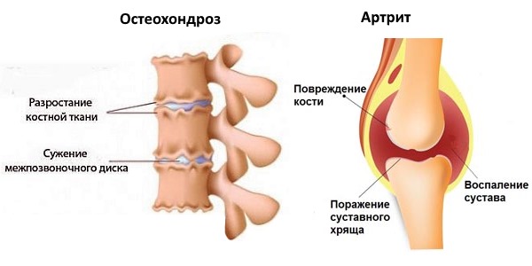 Особой эффективностью Паноксен выделяется при лечении артрита и остеохондроза