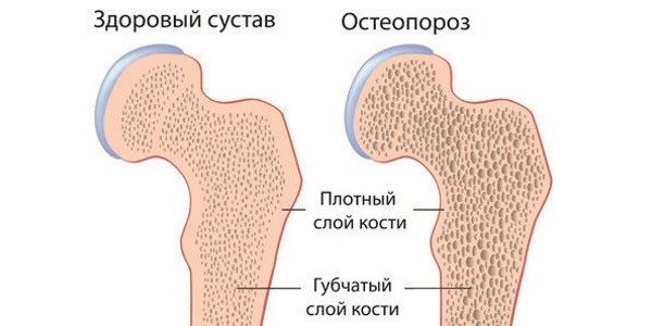 При остеопорозе костная ткань становится менее плотной