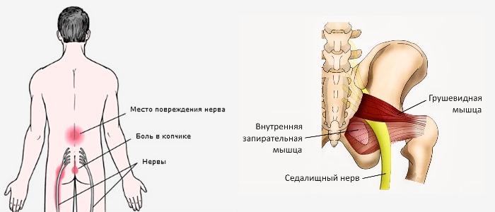 Раптен Рапид помогает избавиться от боли в спине при невралгиях