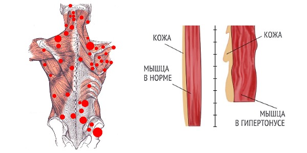 Толизор назначают, если возникают мышечные спазм по причине заболеваний опорно-двигательного аппарата