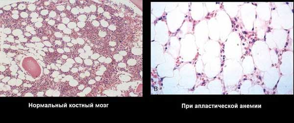 апластическая анемия