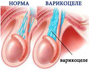 как выглядит варикоцеле