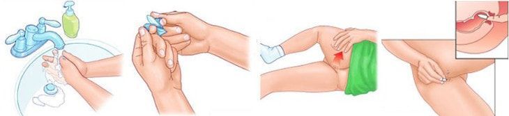 установка свечи ректально