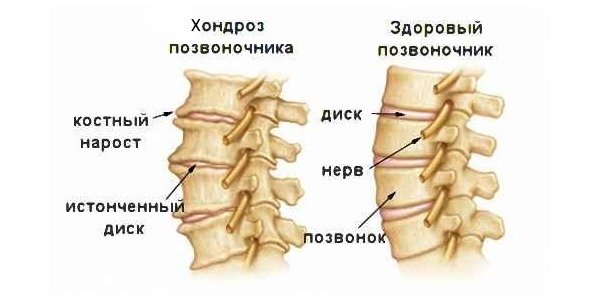 Хондроз - предстадия остеохондроза