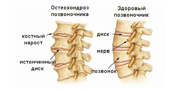 При остеохондрозе изменения в позвоночнике начинаются с межпозвоночных дисков