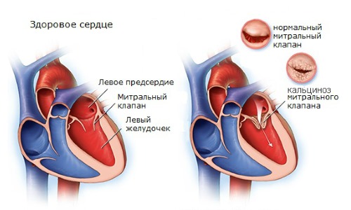 Избыток витамина D2 способствует развитию кальциноза